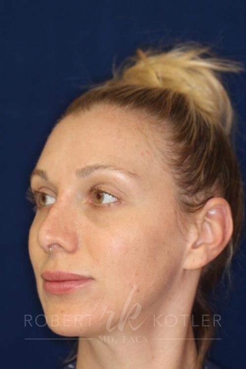 Permanent Non-surgical Revision Rhinoplasty - Left Angle Profile - Before Pic - Permanent filler to restore tip - Thickened skin treated with steroid injections - Best Rhinoplasty Beverly Hills