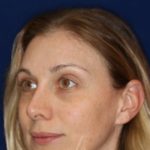 Permanent Non-surgical Revision Rhinoplasty - Left Angle Profile - After Pic - Permanent filler to restore tip - Thickened skin treated with steroid injections - Rhinoplasty Surgeon in Beverly Hills
