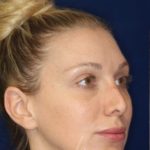 Permanent Non-surgical Revision Rhinoplasty - Right Angle Profile - Before Pic - Permanent filler to restore tip - Thickened skin treated with steroid injections - Nose Job in Beverly Hills