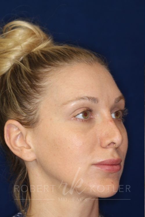 Permanent Non-surgical Revision Rhinoplasty - Right Angle Profile - Before Pic - Permanent filler to restore tip - Thickened skin treated with steroid injections - Nose Job in Beverly Hills