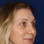 Permanent Non-surgical Revision Rhinoplasty - Right Angle Profile -After Pic - Permanent filler to restore tip - Thickened skin treated with steroid injections - Best Nose Job Surgeon