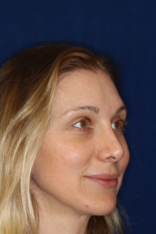Permanent Non-surgical Revision Rhinoplasty - Right Angle Profile -After Pic - Permanent filler to restore tip - Thickened skin treated with steroid injections - Best Nose Job Surgeon