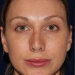 Permanent Non-surgical Revision Rhinoplasty - Front Face - Before Pic - Permanent filler to restore tip - Thickened skin treated with steroid injections - Top Rhinoplasty Surgeon