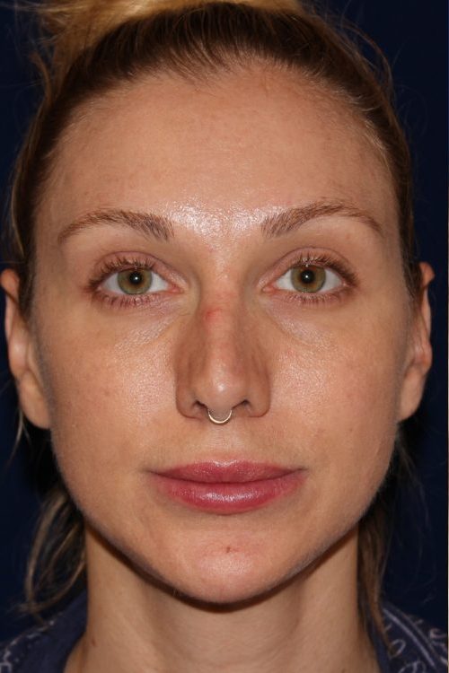 Permanent Non-surgical Revision Rhinoplasty - Front Face - Before Pic - Permanent filler to restore tip - Thickened skin treated with steroid injections - Top Rhinoplasty Surgeon