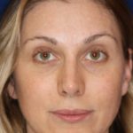 Permanent Non-surgical Revision Rhinoplasty - Front Face - After Pic - Permanent filler to restore tip - Thickened skin treated with steroid injections - Beverly Hills Rhinoplasty Superspecialist