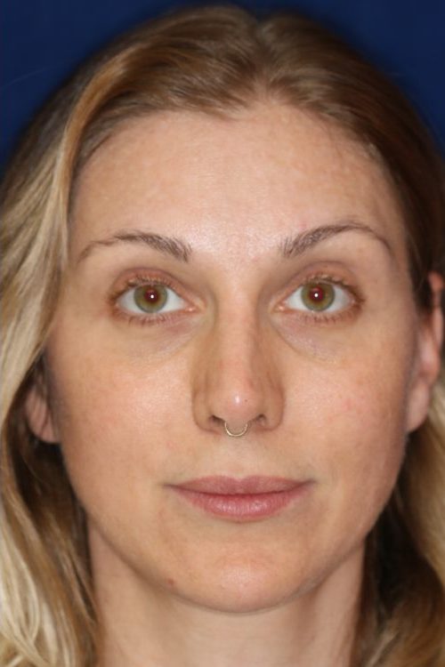 Permanent Non-surgical Revision Rhinoplasty - Front Face - After Pic - Permanent filler to restore tip - Thickened skin treated with steroid injections - Beverly Hills Rhinoplasty Superspecialist
