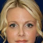 Permanent Non-surgical Revision Rhinoplasty - Front Face View - Before Pic - Crooked nose correction - Tissue loss concealed - Cartilage graft concealed - Top Rhinoplasty Surgeon