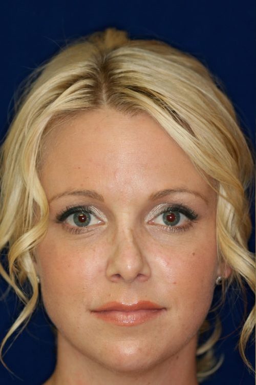 Permanent Non-surgical Revision Rhinoplasty - Front Face View - Before Pic - Crooked nose correction - Tissue loss concealed - Cartilage graft concealed - Top Rhinoplasty Surgeon