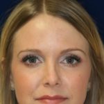 Permanent Non-surgical Revision Rhinoplasty - Front Face View - After Pic - Crooked nose correction - Tissue loss concealed - Cartilage graft concealed - Beverly Hills Rhinoplasty Superspecialist