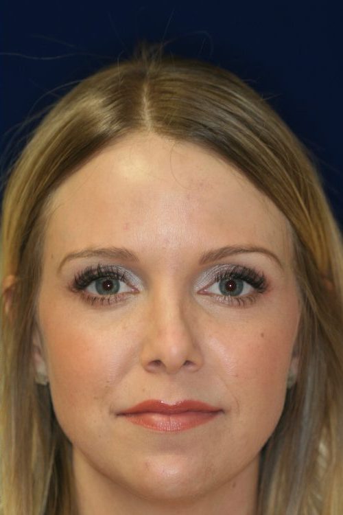 Permanent Non-surgical Revision Rhinoplasty - Front Face View - After Pic - Crooked nose correction - Tissue loss concealed - Cartilage graft concealed - Beverly Hills Rhinoplasty Superspecialist