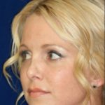 Permanent Non-surgical Revision Rhinoplasty - Left Profile - Before Pic - Crooked nose correction - Tissue loss concealed - Cartilage graft concealed - Best Rhinoplasty Beverly Hills