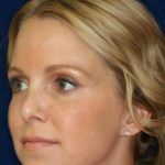 Permanent Non-surgical Revision Rhinoplasty - Left Profile - After Pic - Crooked nose correction - Tissue loss concealed - Cartilage graft concealed - Rhinoplasty Surgeon in Beverly Hills