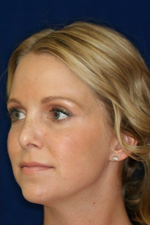 Permanent Non-surgical Revision Rhinoplasty - Left Profile - After Pic - Crooked nose correction - Tissue loss concealed - Cartilage graft concealed - Rhinoplasty Surgeon in Beverly Hills
