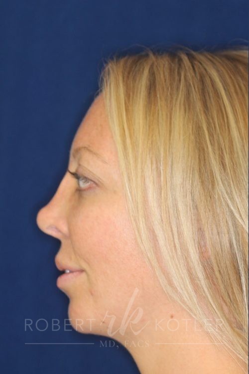 Permanent Non-surgical Revision Rhinoplasty - Left Profile - Before Pic - Correction of nose depression - Tip refinement - Beverly Hills Rhinoplasty Superspecialist