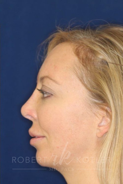 Permanent Non-surgical Revision Rhinoplasty - Left Profile - After Pic - Correction of nose depression - Tip refinement - Best Rhinoplasty Beverly Hills