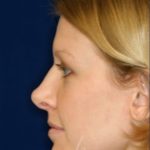 Permanent non-surgical revision rhinoplasty- Right Profile - Before Pic - Over sculpture of bridge - Nose Job in Beverly Hills