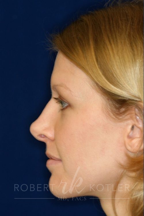 Permanent non-surgical revision rhinoplasty- Right Profile - Before Pic - Over sculpture of bridge - Nose Job in Beverly Hills