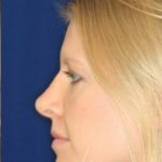 Permanent non-surgical revision rhinoplasty over sculpture, tip correction - Left Profile After - Best Rhinoplasty Beverly Hills