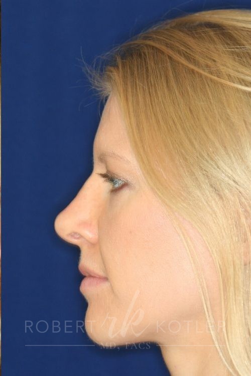 Permanent non-surgical revision rhinoplasty over sculpture, tip correction - Left Profile After - Best Rhinoplasty Beverly Hills