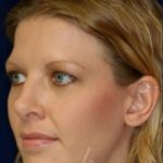 Permanent Non-surgical Revision Rhinoplasty - Left Angled Profile - Before Pic - Permanent filler in nose depression - Tip refinement - Best Nose Job Surgeon