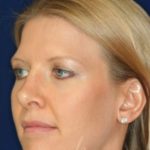 Permanent Non-surgical Revision Rhinoplasty - Left Angled Profile - After Pic - Permanent filler in nose depression - Tip refinement - Top Rhinoplasty Surgeon