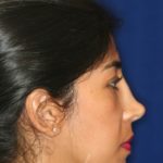 Permanent Non-surgical Revision Rhinoplasty - Right Profile - Before Pic - Correction of irregular bridge - Natural tip restored - Beverly Hills Rhinoplasty Superspecialist