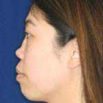 Permanent non-surgical rhinoplasty - Left Profile - Before Pic - Permanent filler - Pre-injury appearance restored - Nose Job in Beverly Hills
