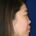 Permanent non-surgical rhinoplasty - Right Profile - Before Pic - Permanent filler - Pre-injury appearance restored - Top Rhinoplasty Surgeon