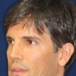 Permanent Non-surgical Rhinoplasty - Left Angled Profile - After Pic - Restoration of collapsed bridge - extended neck sculpture - Rhinoplasty Surgeon in Beverly Hills
