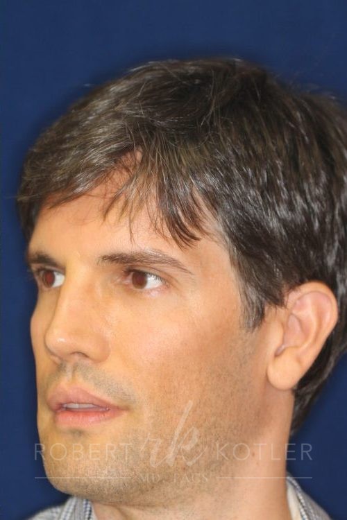 Permanent Non-surgical Rhinoplasty - Left Angled Profile - After Pic - Restoration of collapsed bridge - extended neck sculpture - Rhinoplasty Surgeon in Beverly Hills