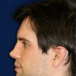 Permanent Non-surgical Rhinoplasty - Left Profile - Before Pic - Restoration of collapsed bridge - extended neck sculpture - Top Rhinoplasty Surgeon