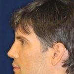 Permanent Non-surgical Rhinoplasty - Left Profile - After Pic - Restoration of collapsed bridge - extended neck sculpture - Beverly Hills Rhinoplasty Superspecialist