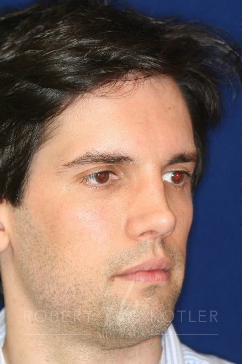 Permanent Non-surgical Rhinoplasty - Right Angled Profile - Before Pic - Restoration of collapsed bridge - extended neck sculpture - Nose Job in Beverly Hills
