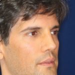 Permanent Non-surgical Rhinoplasty - Right Angled Profile - After Pic - Restoration of collapsed bridge - extended neck sculpture - Best Nose Job Surgeon