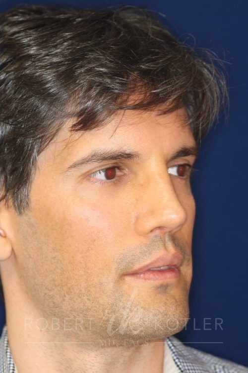 Permanent Non-surgical Rhinoplasty - Right Angled Profile - After Pic - Restoration of collapsed bridge - extended neck sculpture - Best Nose Job Surgeon