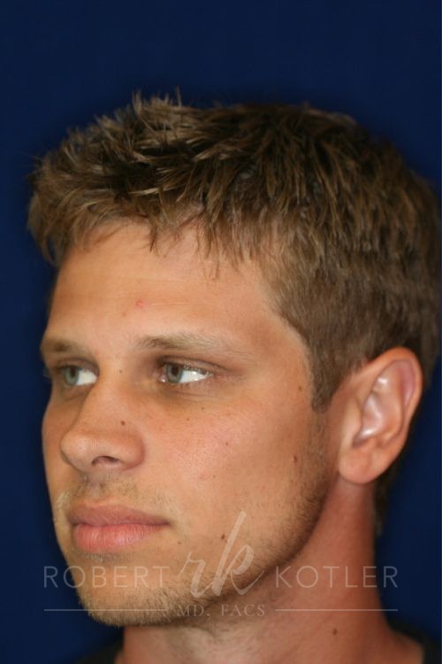 Permanent Non-surgical Rhinoplasty - Left Angled Profile - Before Pic - Hump removal - Raising of low bridge - Tip refinement - Permanent filler - Best Rhinoplasty Beverly Hills