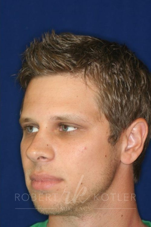 Permanent Non-surgical Rhinoplasty - Left Angled Profile - After Pic - Hump removal - Raising of low bridge - Tip refinement - Permanent filler - Rhinoplasty Surgeon in Beverly Hills