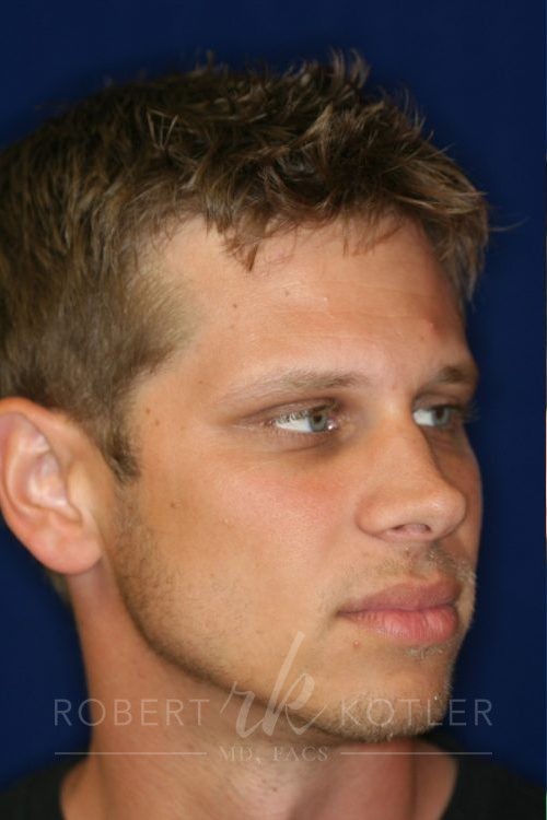 Permanent Non-surgical Rhinoplasty -Right Profile - Before Pic - Hump removal - Raising of low bridge - Tip refinement - Permanent filler - Nose Job in Beverly Hills