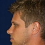Permanent Non-surgical Rhinoplasty - Left Profile - Before Pic - Hump removal - Raising of low bridge - Tip refinement - Permanent filler - Top Rhinoplasty Surgeon