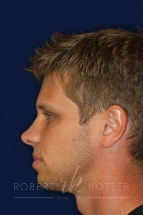 Permanent Non-surgical Rhinoplasty - Left Profile - Before Pic - Hump removal - Raising of low bridge - Tip refinement - Permanent filler - Top Rhinoplasty Surgeon