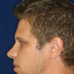 Permanent Non-surgical Rhinoplasty - Left Profile - After Pic - Hump removal - Raising of low bridge - Tip refinement - Permanent filler - Beverly Hills Rhinoplasty Superspecialist