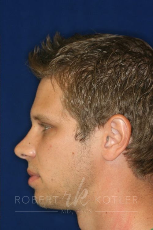 Permanent Non-surgical Rhinoplasty - Left Profile - After Pic - Hump removal - Raising of low bridge - Tip refinement - Permanent filler - Beverly Hills Rhinoplasty Superspecialist