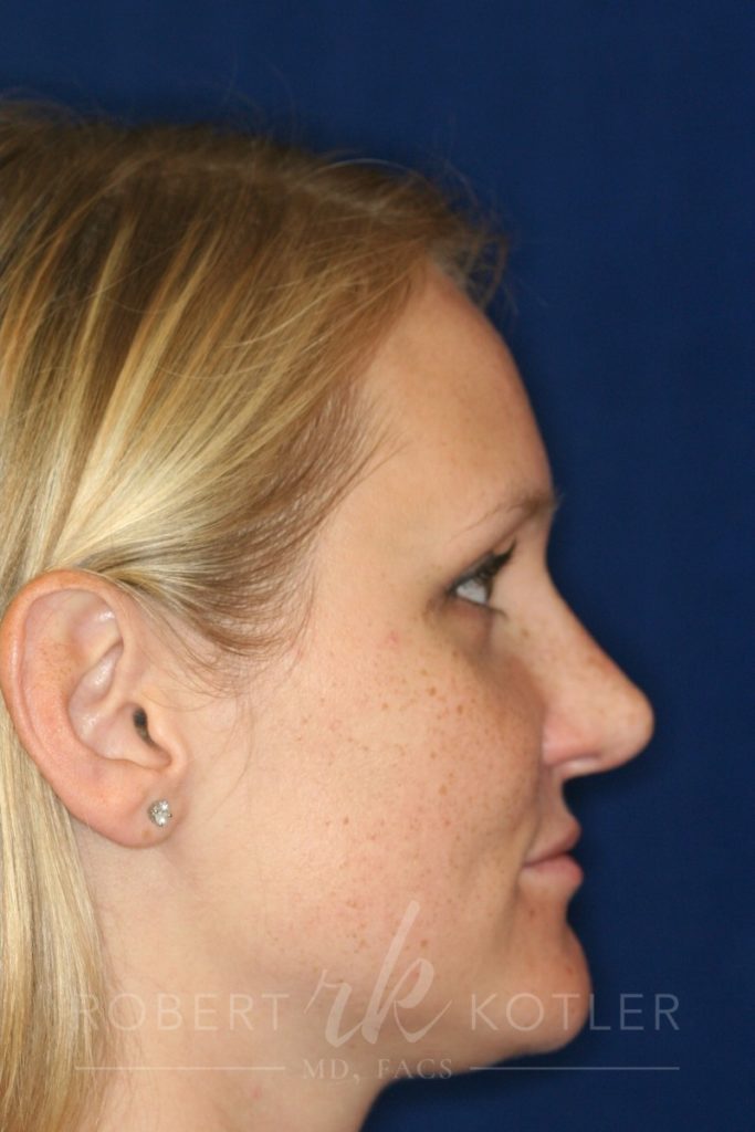 Closed Rhinoplasty - Right Profile - After Pic - Hump removal - Nose recessed closer to face - Rhinoplasty Surgeon in Beverly Hills
