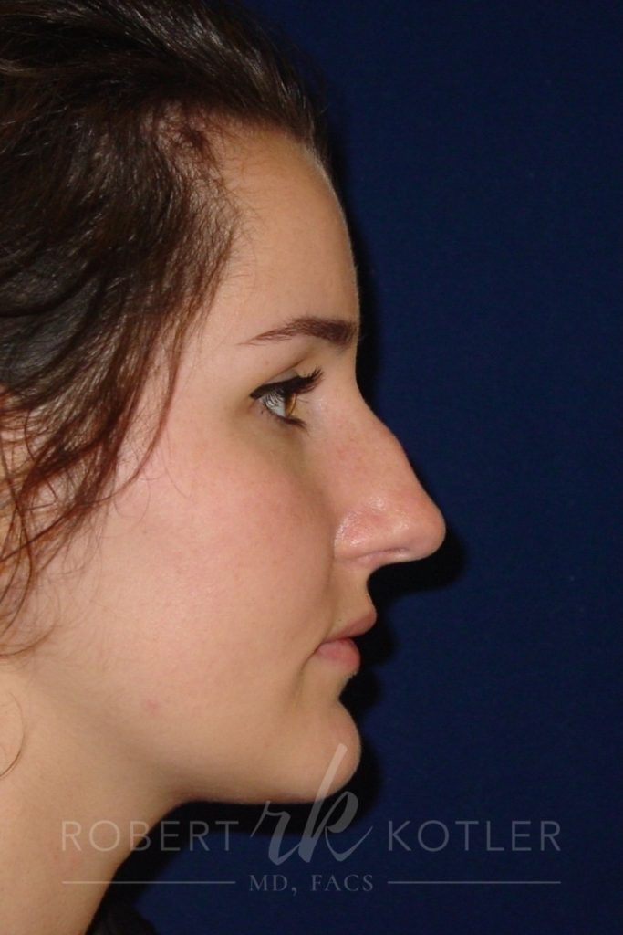 Closed Rhinoplasty - Right Profile - Before Pic - Hump removal - Tip refinement - Nose tip elevated from lip - Top Rhinoplasty Surgeon