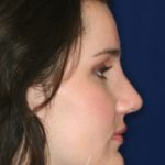 Closed Rhinoplasty - Right Profile - After Pic - Hump removal - Tip refinement - Nose tip elevated from lip - Beverly Hills Rhinoplasty Superspecialist