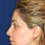 Closed Rhinoplasty - Hump Removal, refined tip, nose elevated from lip - Left Profile - After Pic - Beverly Hills Rhinoplasty Superspecialist