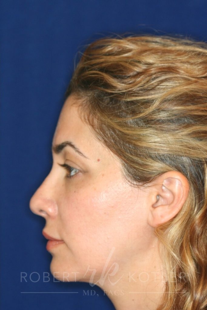 Closed Rhinoplasty - Hump Removal, refined tip, nose elevated from lip - Left Profile - After Pic - Beverly Hills Rhinoplasty Superspecialist