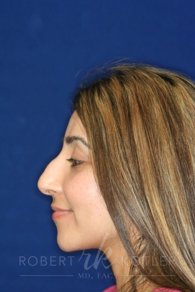 Closed Rhinoplasty - Bump removal - refined tip - slight elevation from lip - Left Profile - Before Pic - Top Rhinoplasty Surgeon