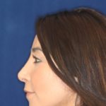 Closed Rhinoplasty - Bump removed, tip refined, elevated from lip - Left Profile - After Pic - Best Rhinoplasty Beverly Hills