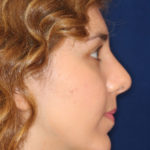 Rhinoplasty - Right Profile - After Pic - Hump removal - Nose tip refinement - Chin augmentation - Rhinoplasty Surgeon in Beverly Hills